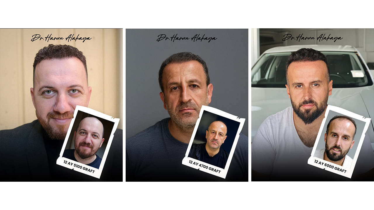 Dr. Harun Alakaya saç ekimi öncesi sonrası sonuçları 12 ay