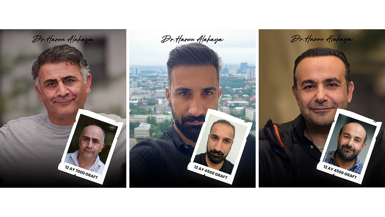 Dr. Harun Alakaya saç ekimi öncesi sonrası sonuçları 1 yıl