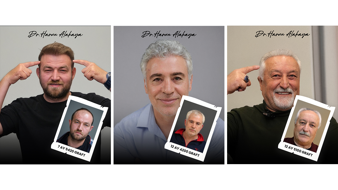 Dr. Harun Alakaya saç ekimi öncesi sonrası sonuçları 7 ay 12 ay