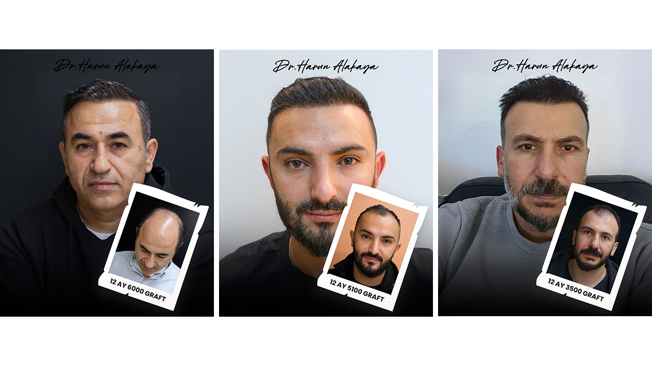 Dr. Harun Alakaya saç ekimi öncesi sonrası sonuçları 12 ay sonuç