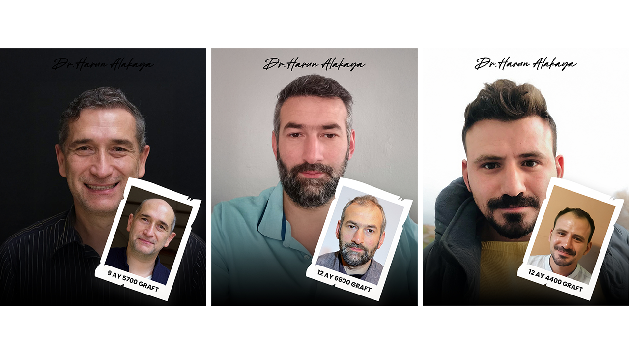 Dr. Harun Alakaya saç ekimi öncesi sonrası sonuçları 9 ay 12 ay