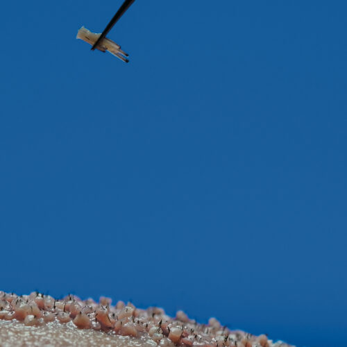 Dr. Harun Alakaya kliniği teknikleri