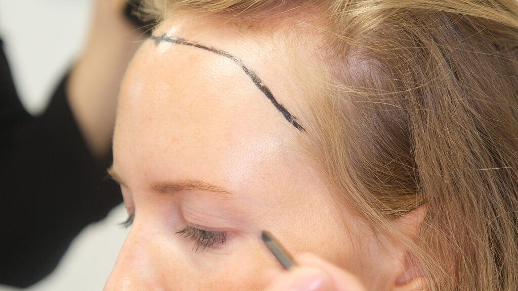 Dr. Harun Alakaya kliniği saç işlemi öncesi