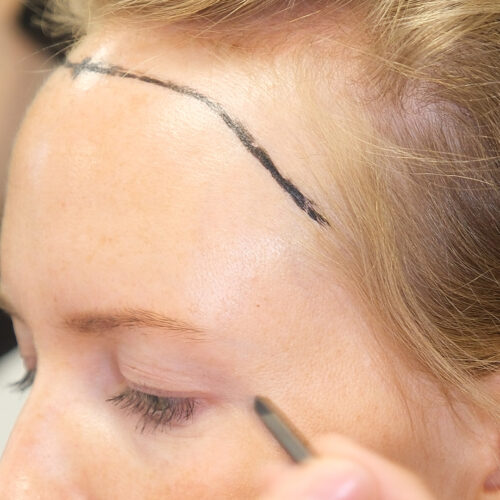 Dr. Harun Alakaya kliniği saç işlemi öncesi