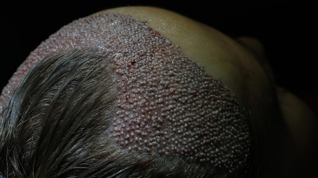 Dr. Harun Alakaya kliniği saç işlemi sonrası