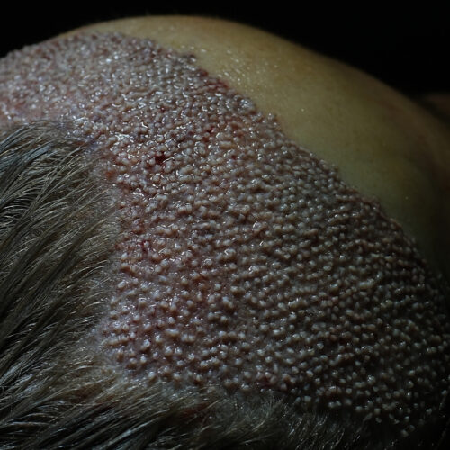 Dr. Harun Alakaya kliniği saç işlemi sonrası