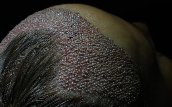 Dr. Harun Alakaya kliniği saç işlemi sonrası