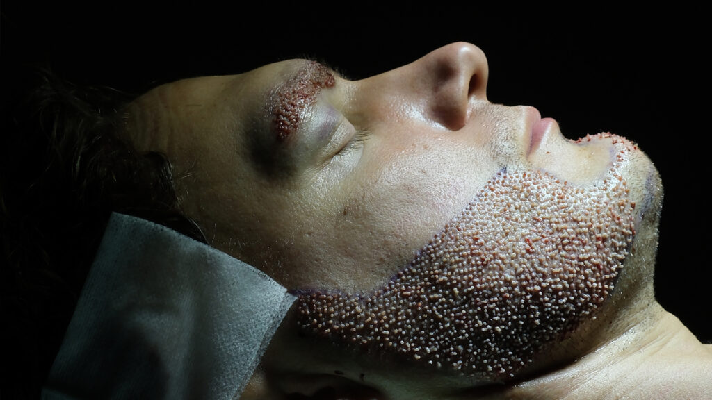 Dr. Harun Alakaya kliniği sakal ekimi