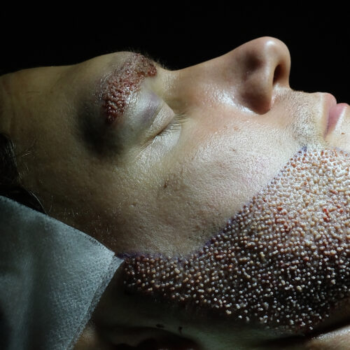 Dr. Harun Alakaya kliniği sakal ekimi