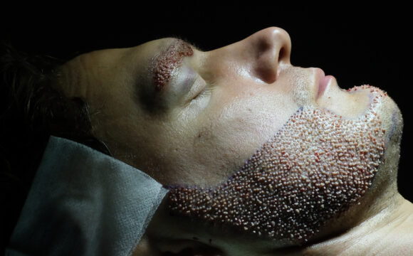 Dr. Harun Alakaya kliniği sakal ekimi